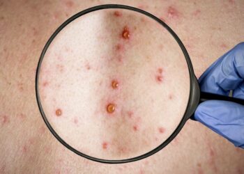 Se reportó un caso sospechoso de viruela símica en el país